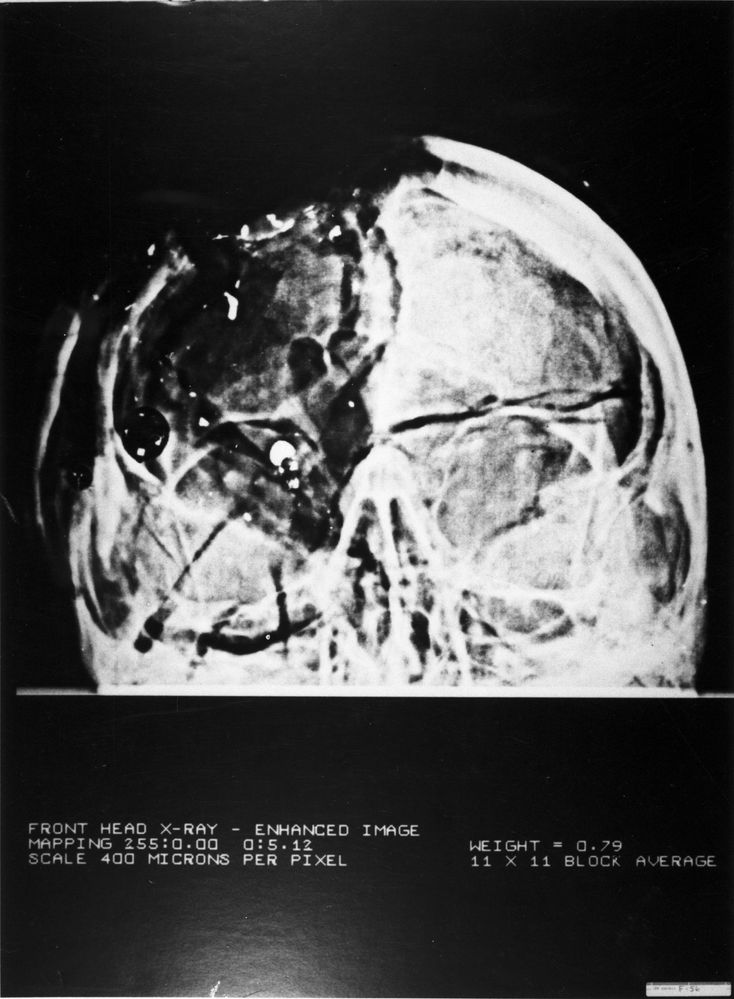 Kennedy Anterior/Posterior X-Ray from Autopsy